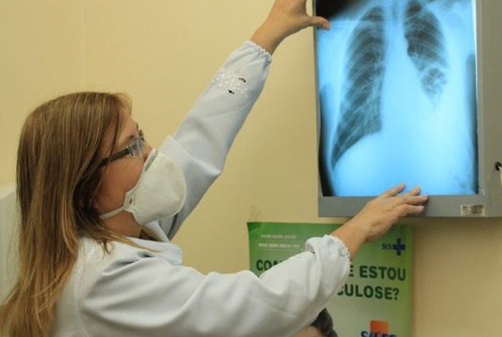 Governo Federal cria comitê para eliminar a tuberculose