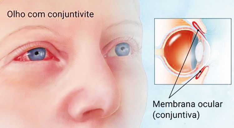 Aumento dos casos de conjuntivite em Viçosa preocupa